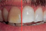 beljenje zuba pre i posle