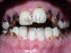 Pokvareni zubi